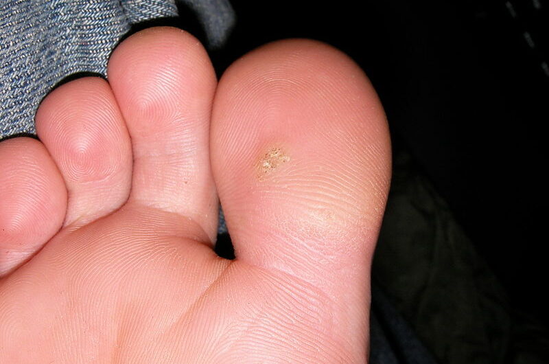 Czym są kurzajki? Jak wybrać skuteczny preparat do usuwania kurzajek?