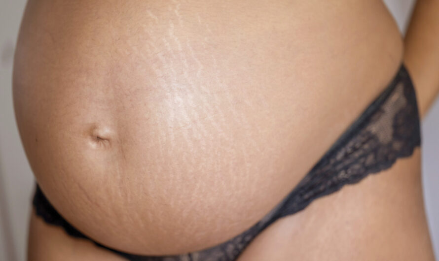 Jak skutecznie zapobiegać rozstępom w ciąży